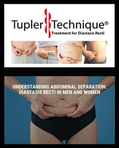 Understanding Abdominal Separation: Diastasis Recti in Men and Women