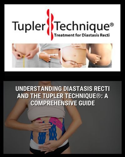 Understanding Diastasis Recti and the Tupler Technique®: A Comprehensive Guide