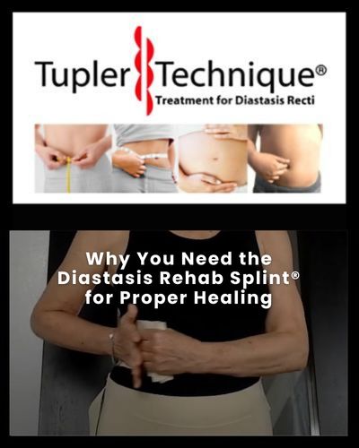 Why You Need the Diastasis Rehab Splint for Proper Healing - Diastasis Rehab