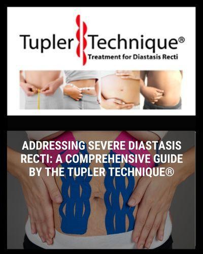 Addressing Severe Diastasis Recti: A Comprehensive Guide by The Tupler Technique®