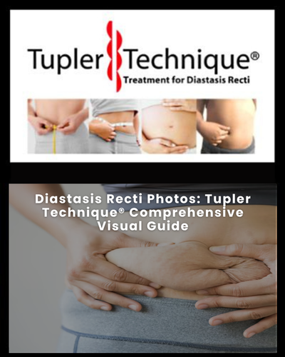 Diastasis Recti Photos: Tupler Technique® Comprehensive Visual Guide