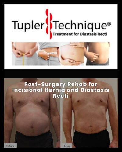 Post-Surgery Rehab for Incisional Hernia and Diastasis Recti