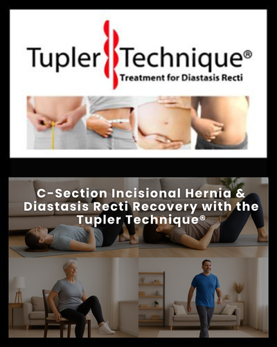 C-Section Incisional Hernia & Diastasis Recti Recovery - Diastasis Rehab