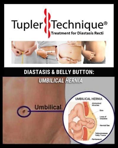 DIASTASIS & BELLY BUTTON: UMBILICAL HERNIA - diastasisrehab