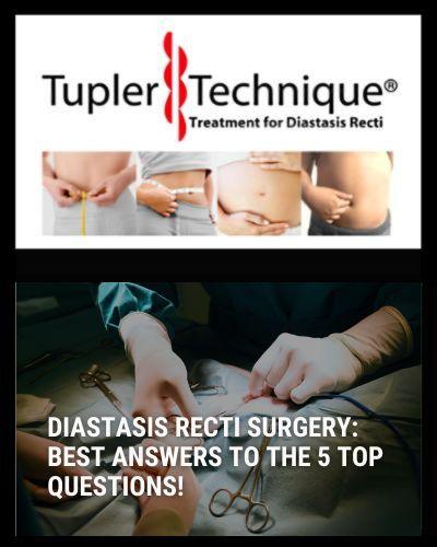 Diastasis Recti Surgery: Best Answers to The 5 Top Questions! - diastasisrehab