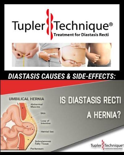 Diastasis Recti vs. Hernia: Causes, Side-Effects & Differences Unveiled - diastasisrehab