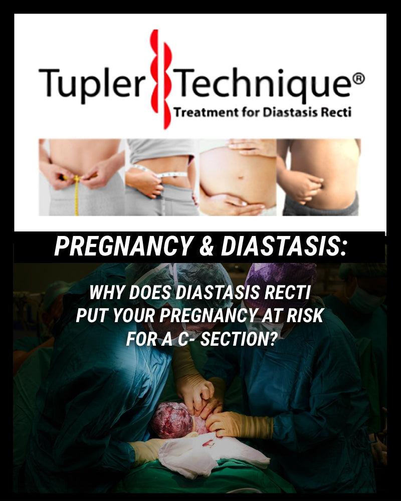 Did You Know Diastasis Recti Put's Your Pregnancy at Risk For a C- Section?