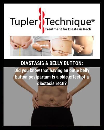 Did you know that having an outie belly button postpartum is a side effect of a diastasis recti? - diastasisrehab