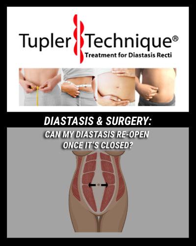 Forever Fixed? Can My Diastasis Recti Re-Open After Closing? - diastasisrehab