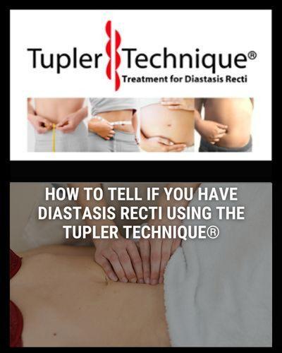 How to Tell if You Have Diastasis Recti Using the Tupler Technique®