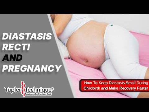 Pregnancy and Diastasis: A Hidden Concern You Need to Know About