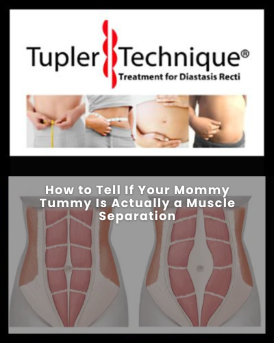 How to Tell If Your Mommy Tummy Is Actually a Muscle Separation