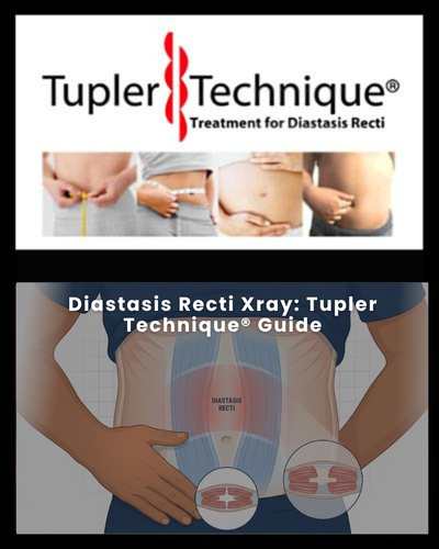 Diastasis Recti Xray: Tupler Technique® Guide