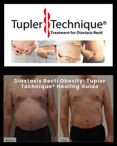 Diastasis Recti Obesity: Tupler Technique® Healing Guide