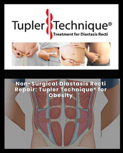 Non-Surgical Diastasis Recti Repair: Tupler Technique® for Obesity