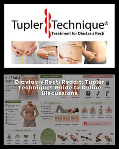 Diastasis Recti Reddit: Tupler Technique® Guide to Online Discussions