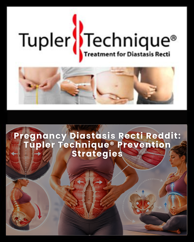 Pregnancy Diastasis Recti Reddit: Tupler Technique® Prevention Strategies