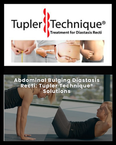 Abdominal Bulging Diastasis Recti: Tupler Technique® Solutions