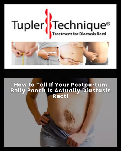 How to Tell If Your Postpartum Belly Pooch Is Actually Diastasis Recti
