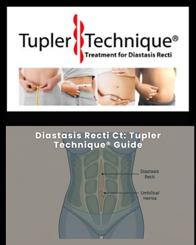 Diastasis Recti Ct: Tupler Technique® Guide