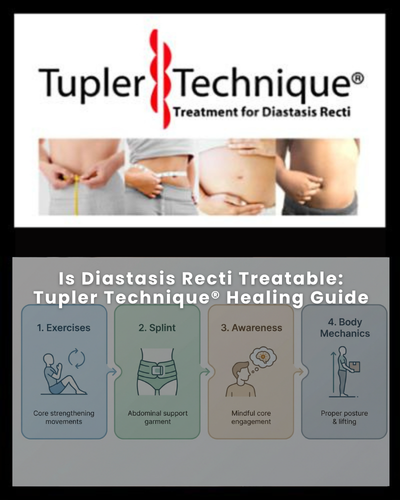Is Diastasis Recti Treatable: Tupler Technique® Healing Guide