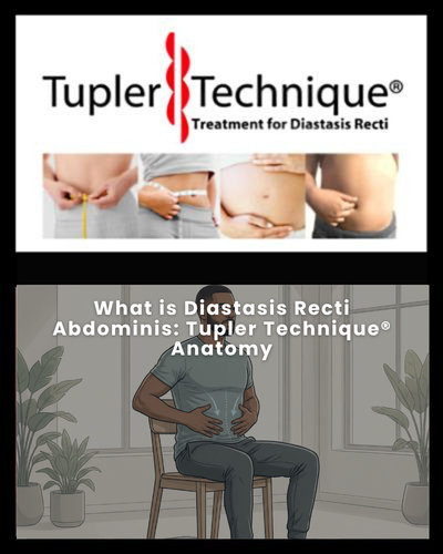 What is Diastasis Recti Abdominis: Tupler Technique® Anatomy