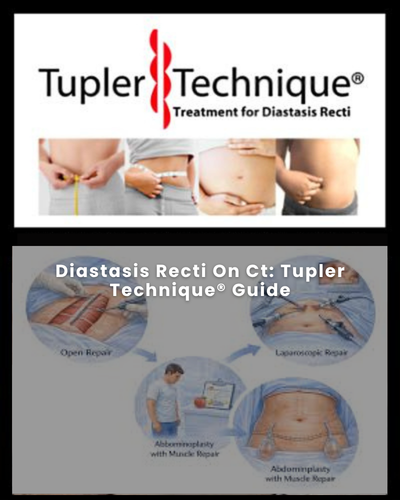 Diastasis Recti On Ct: Tupler Technique® Guide