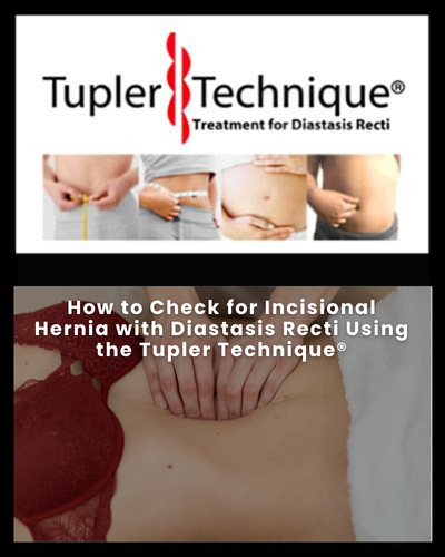 How to Check for Incisional Hernia with Diastasis Recti Using the Tupler Technique