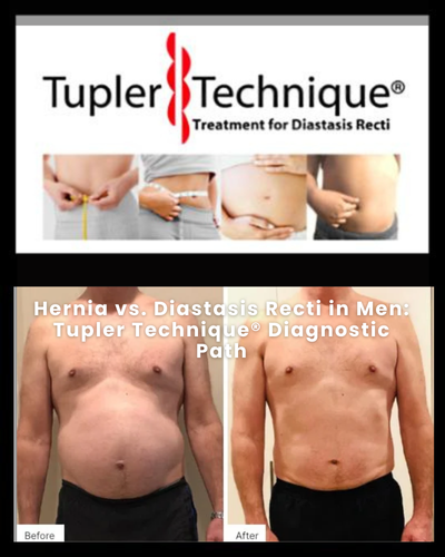 Hernia vs. Diastasis Recti in Men: Tupler Technique® Diagnostic Path