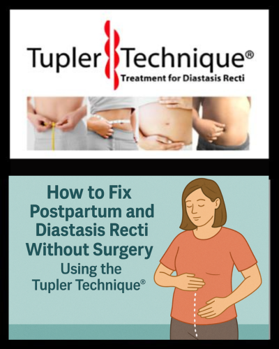 How to Fix Postpartum during pregnancy and Diastasis Recti Without Surgery Using the Tupler Technique
