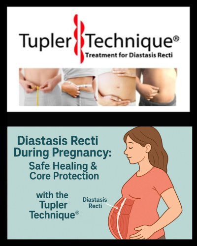 Diastasis Recti During Pregnancy: Safe Healing & Core Protection with the Tupler Technique®