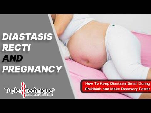 Pregnancy and Diastasis: A Hidden Concern You Need to Know About - diastasisrehab