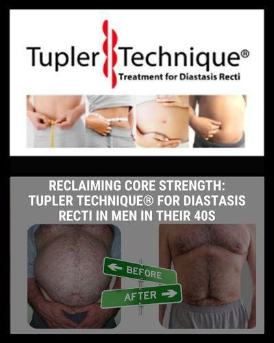 Reclaiming Core Strength: Tupler Technique® for Diastasis Recti Exercises For in Men in Their 40s - diastasisrehab