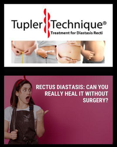 Rectus Diastasis: Can You Really Heal It Without Surgery? - Julie Tupler, RN - diastasisrehab