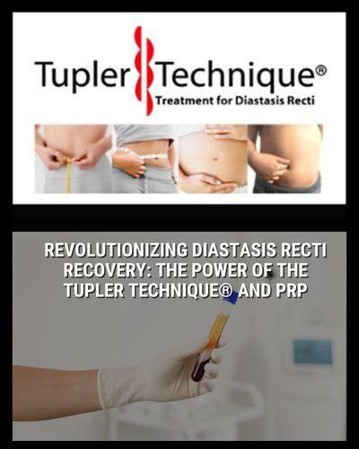 Revolutionizing Diastasis Recti Recovery: The Power of the Tupler Technique® and PRP - diastasisrehab