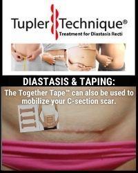 Scar Mobilization Techniques for Healing After Surgery - diastasisrehab