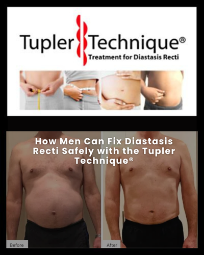 How Men Can Fix Diastasis Recti Safely with the Tupler Technique