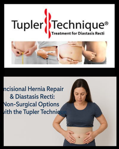 Incisional Hernia Repair & Diastasis Recti: Non-Surgical Options with the Tupler Technique®