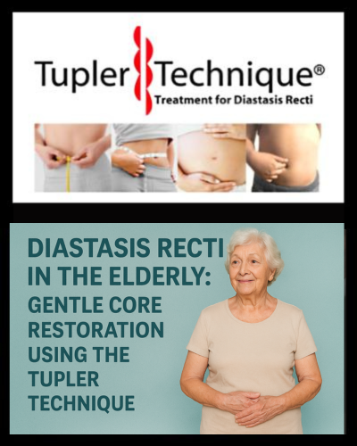 Diastasis Recti in the Elderly: Gentle Core Restoration Using the Tupler Technique