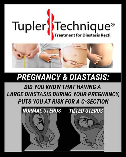 The Hidden Risks of Diastasis Recti: Beyond Appearance - diastasisrehab