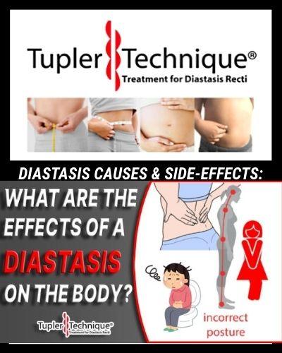 The Impact of Diastasis Recti on Your Body: Understanding the Effects - diastasisrehab