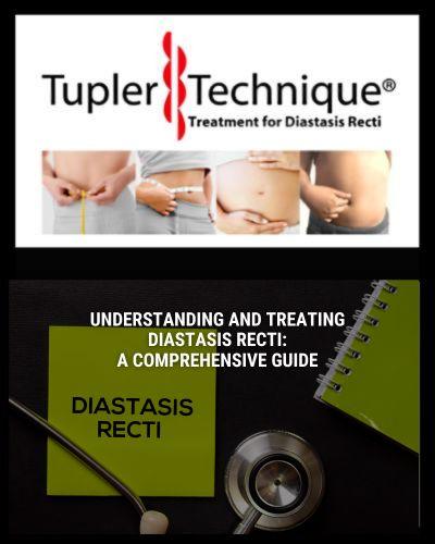 Understanding and Treating Diastasis Recti: A Comprehensive Guide - diastasisrehab