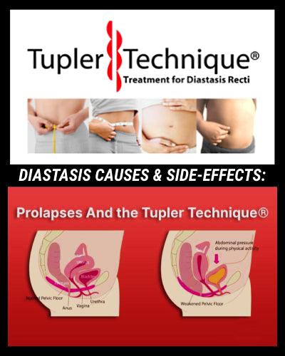 Understanding Diastasis Causes & Side-Effects: Prolapses and the Tupler Technique® - diastasisrehab