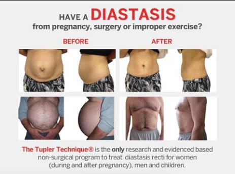 Understanding Diastasis Recti Symptoms and How To Effectively Manage It - diastasisrehab