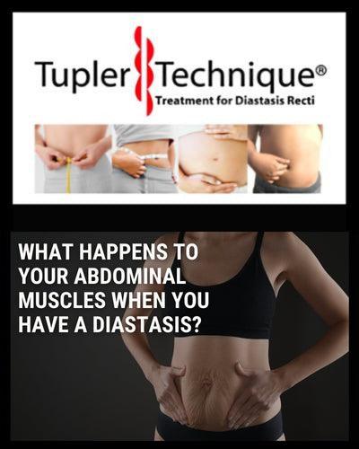 What Happens to Your Abdominal Muscles When You Have A Diastasis? - diastasisrehab